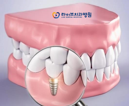 증상에 맞는 치료플랜, 내게 맞는 임플란트치과는? 관련 이미지 2