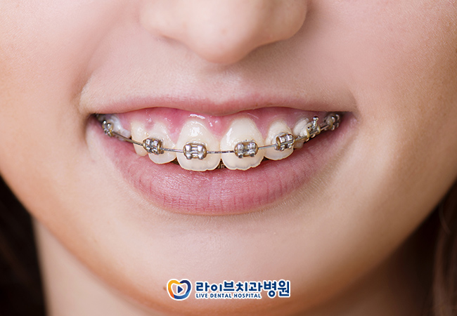 설측교정 무엇을 알아봐야할까? 관련 이미지 2