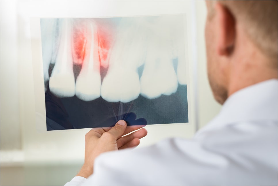 충치치료 아픈가요 통증 정도는? 관련 이미지 5