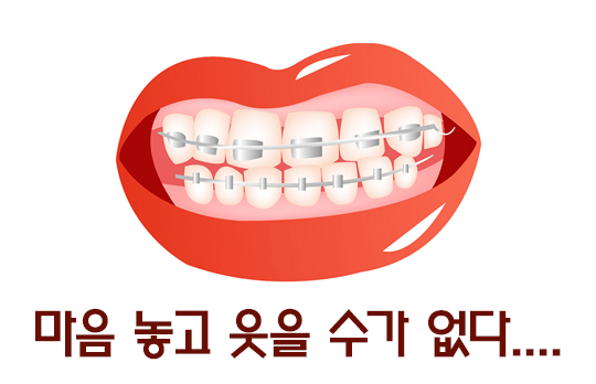 설측교정으로 교정을 숨겨보자! 관련 이미지 3