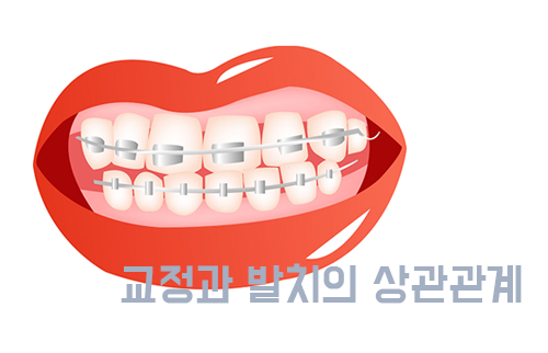 발치교정의 필요성은 무엇일까? 관련 이미지 3