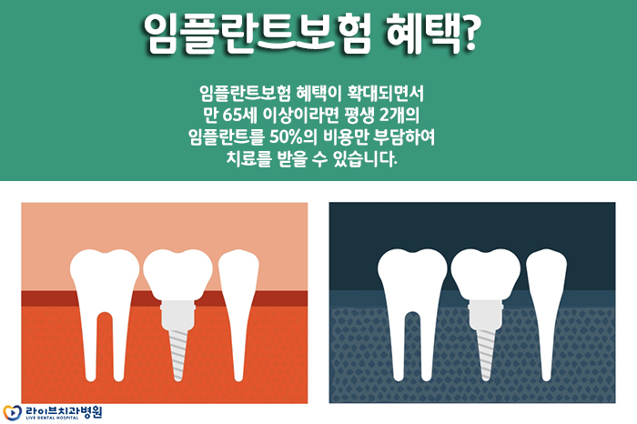임플란트보험 적용되는지 꼼꼼하게 알아두자 관련 이미지 2