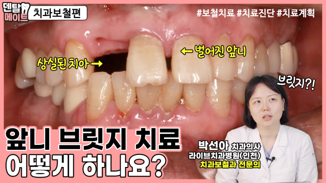 벌어진 앞니 보철 치료하는 방법 2탄[브릿지 치료, 임플란트, 치료진단, 치료계획]｜덴탈메이트 관련 이미지 1