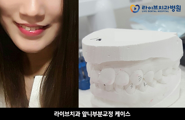앞니부분교정, 내게도 적합한 치료일까? 관련 이미지 2
