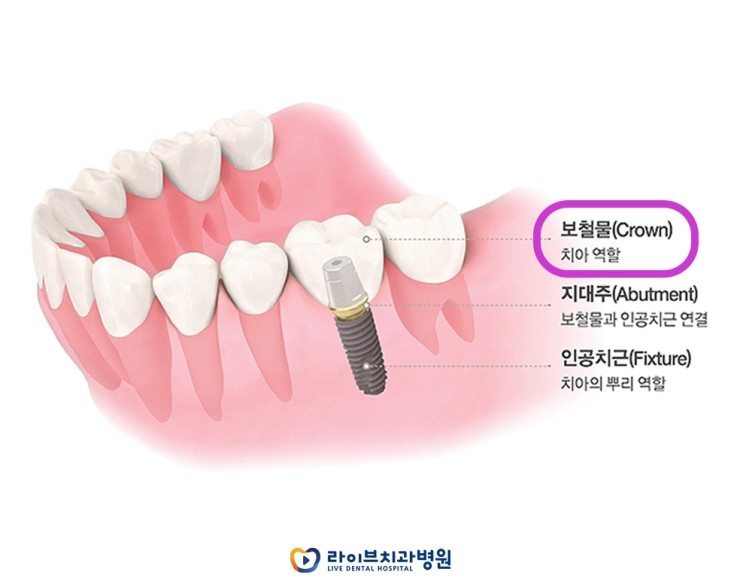 [4월세미나]2020라이브 닥터세미나 - 임플란트 보철이란? 관련 이미지 2