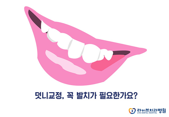 덧니교정, 꼭 발치가 필요한가요? 관련 이미지 2