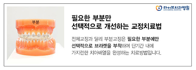 앞니부분교정, 부담없이 원하는 부위만 확실하게 관련 이미지 4