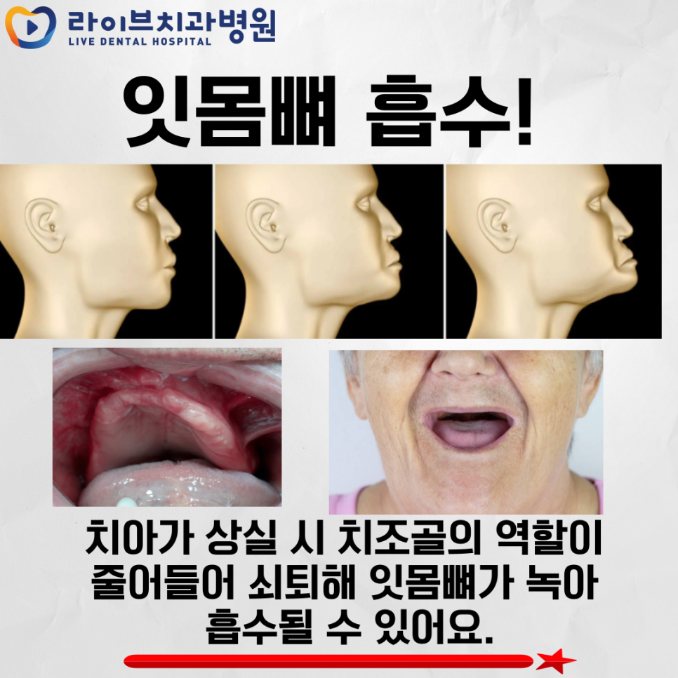 치아 상실 방치하면 부작용이?! 관련 이미지 4