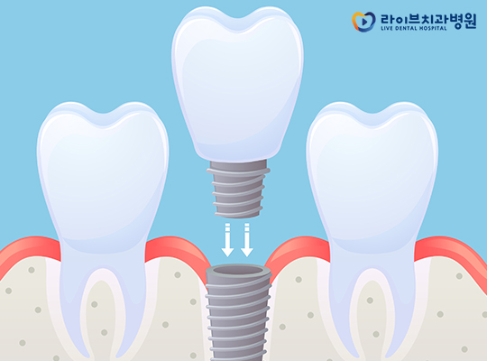 인천임플란트, 그 선택의 기준은? 관련 이미지 3