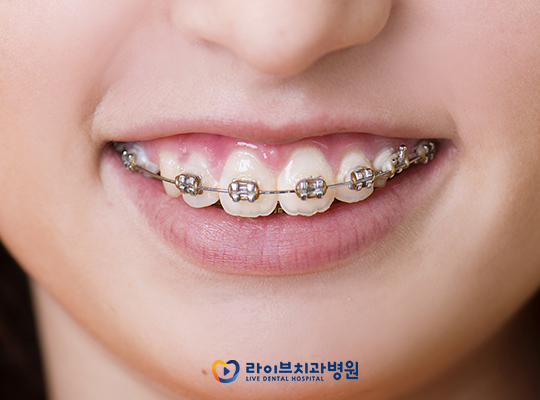 [Yes or No]교정하면 진짜 살이 빠지나요? 관련 이미지 2