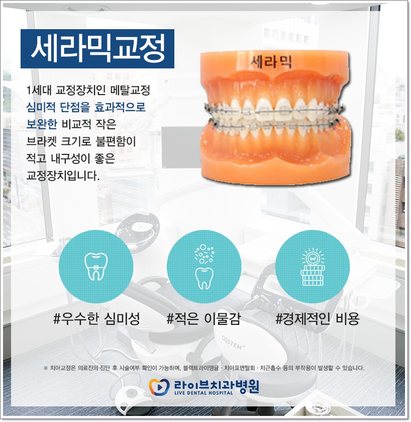 치아교정비용 종류에 따라서 관련 이미지 3