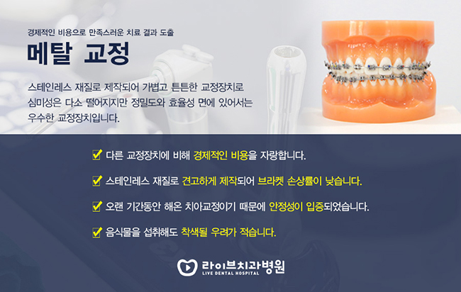 치아교정기 종류 올바르게 알아보자 관련 이미지 2