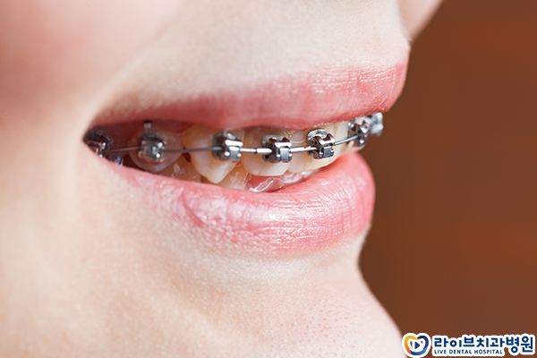 치아교정 통증 얼만큼 느껴질까요? 관련 이미지 3