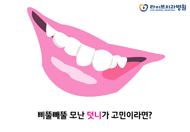 덧니교정, 모난 치열을 바로 잡는 법 관련 이미지 2