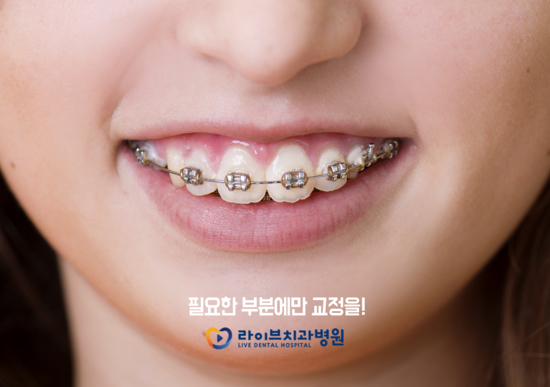 나도 부분교정이 가능할까? 관련 이미지 2