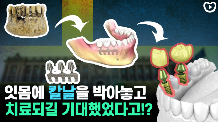 우연으로 발견한 최초의 임플란트는 어떻게 만들어졌을까? | 임플란트 역사, 임플란트 실험, 퍼 잉바르 브레네막, 골유착, 우연 관련 이미지 1