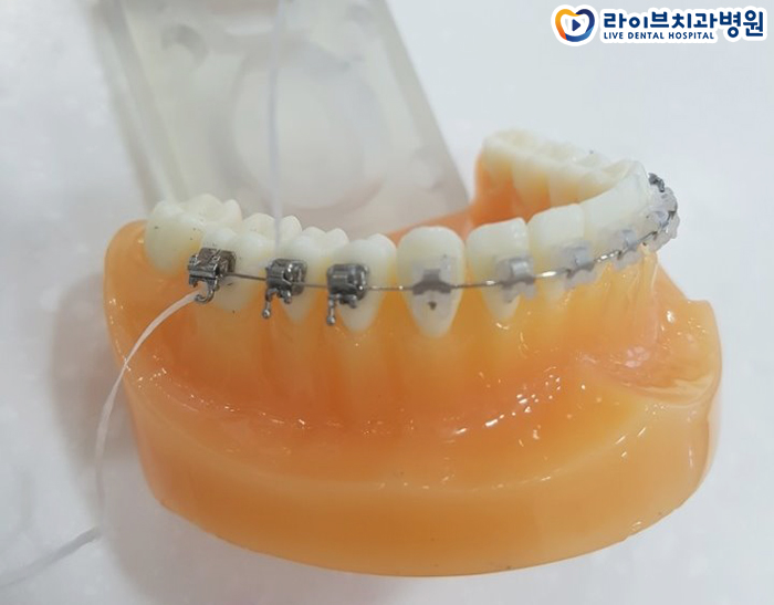 치아교정 양치질 어떻게 해야할까 관련 이미지 3