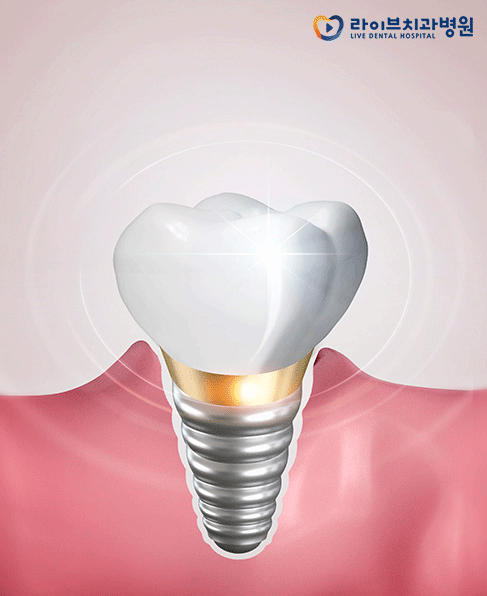 앞니임플란트, 미소에 자신감을 채워요! 관련 이미지 3