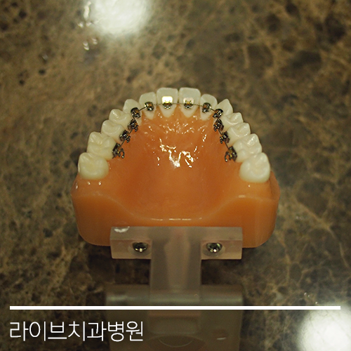 다양한 교정기의 종류들! 관련 이미지 6