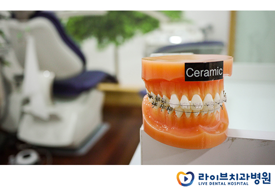 교정기의 다양한 종류를 알아보자! 관련 이미지 4