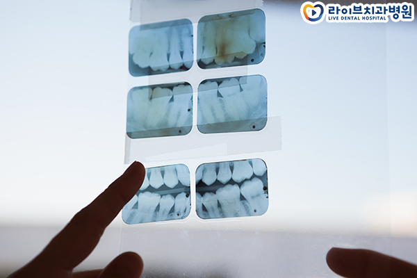 임플란트비용 얼만큼 생각하시나요? 관련 이미지 3