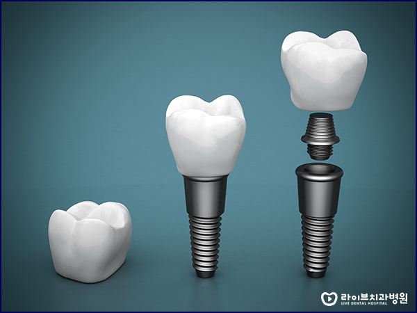 강남임플란트 어떤 걸 고민하고 계신가요? 관련 이미지 2