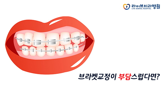 투명교정, 결혼이나 면접을 앞두고 있어도 오케이! 관련 이미지 2