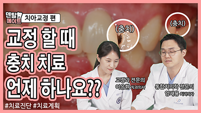 충치가 많은 부정교합의 치아교정방법 미리 알아보기 | 라이브치과병원 관련 이미지 1