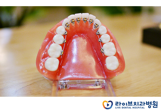 교정기의 다양한 종류를 알아보자! 관련 이미지 6