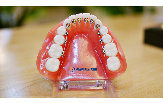 치아교정, 방법과 과정은? 관련 이미지 7