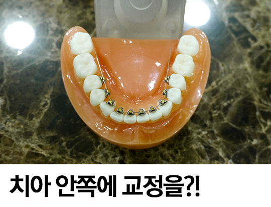 설측교정, 보이지 않는다 아무것도! 관련 이미지 5