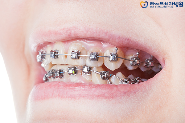 치아교정가격 차근차근 알아보자! 관련 이미지 4