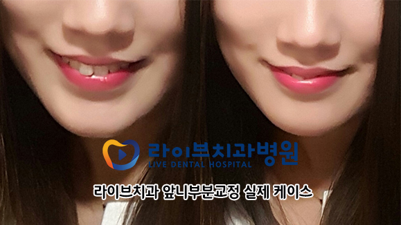 앞니교정, 앞니를 빠르게 개선하는 방법 관련 이미지 2