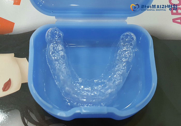 앞니교정, 부담없이 부분적으로 개선해보자 관련 이미지 6