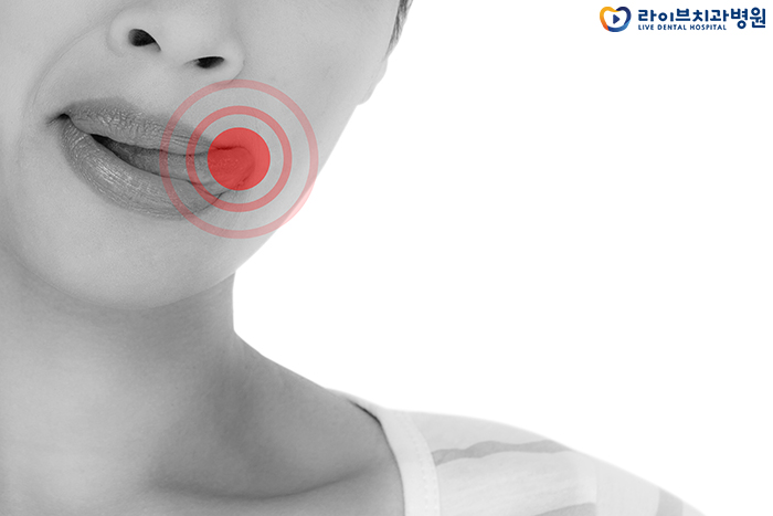 혀 밑 돌기 왜 생기는건가요 관련 이미지 2