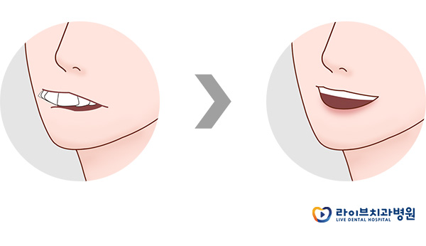 돌출입교정, 입툭튀를 벗어나는 방법 관련 이미지 3