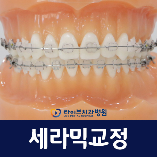 세라믹교정, 어떤 장점들이 있을까요? 관련 이미지 1