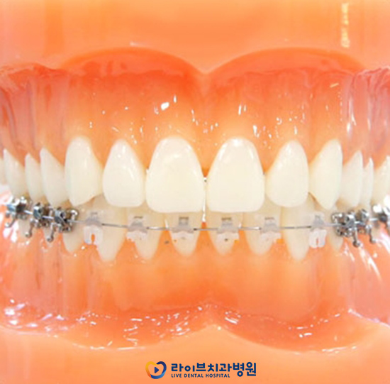 콤비교정 선택하려는 이유는? 관련 이미지 5