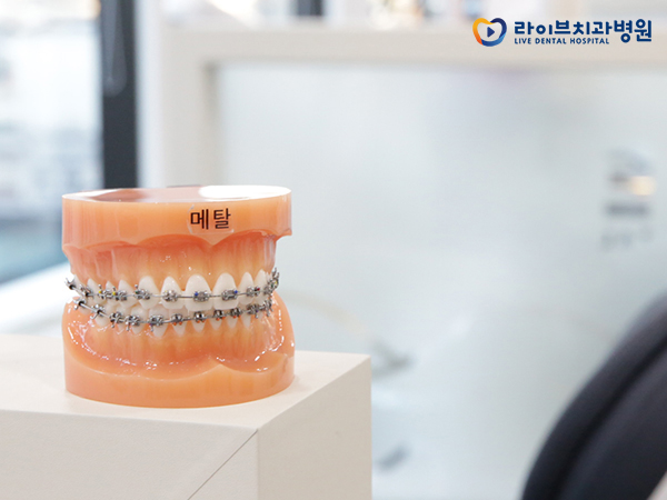 치아교정장치, 장점과 단점은 무엇일까요? 관련 이미지 6