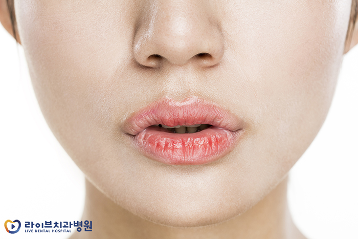입술 갈라짐 원인이 뭘까? 관련 이미지 2