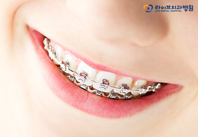 치아교정비용, 정확한 플랜으로 올바른 치료를! 관련 이미지 2