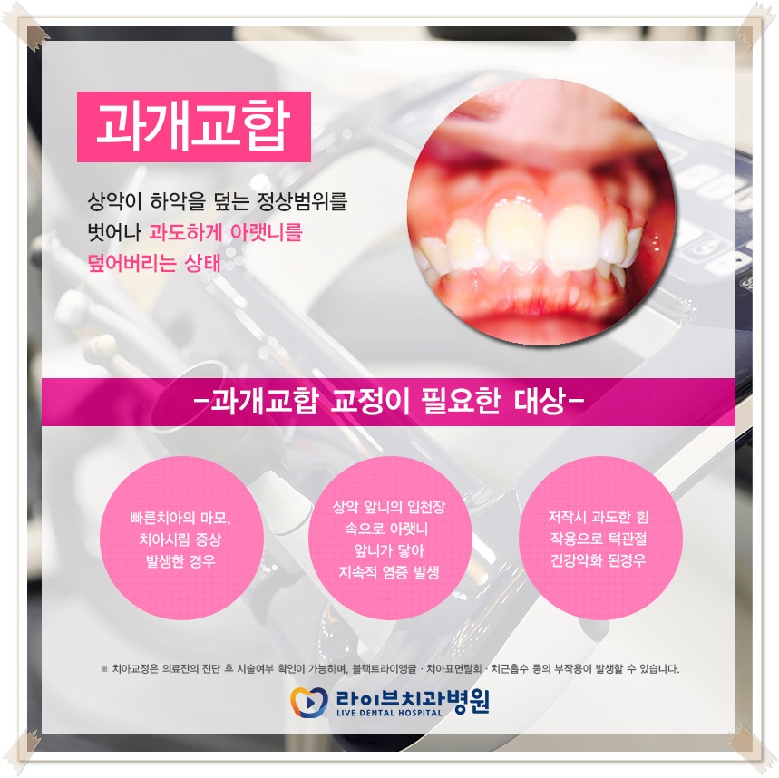 치아교정종류 상황에 맞게! 관련 이미지 2