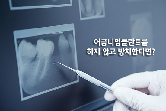 어금니임플란트 심미성과 기능을 한 번에! 관련 이미지 3