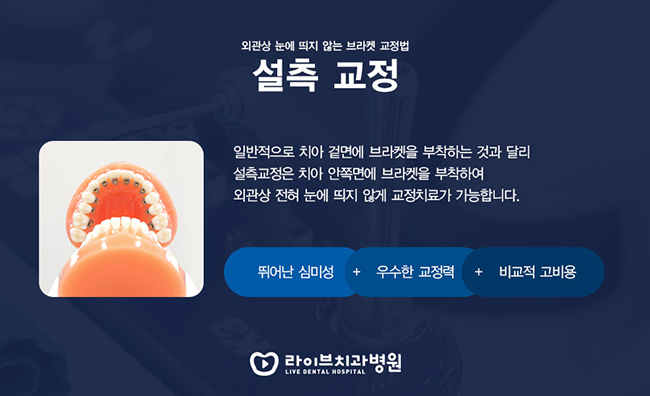 치아교정기 종류 올바르게 알아보자 관련 이미지 5