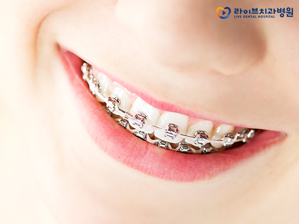 치아교정 시 주의사항은 뭐가 있을까? 관련 이미지 6