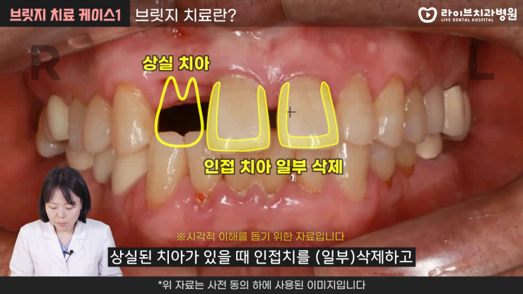 벌어진 앞니 보철 치료하는 방법 2탄[브릿지 치료, 임플란트, 치료진단, 치료계획]｜덴탈메이트 관련 이미지 2