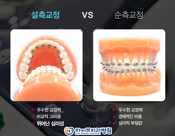 설측교정 티나지 않게 교정하려면 관련 이미지 2