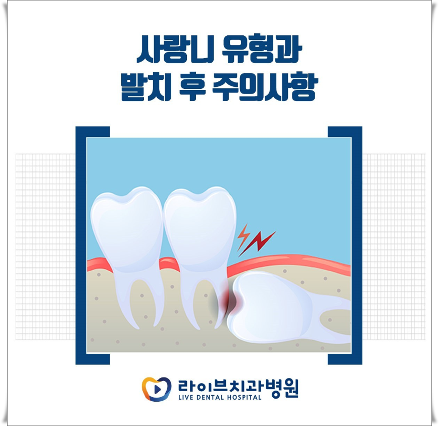 사랑니 유형과 발치 후 주의사항 정보 관련 이미지 1