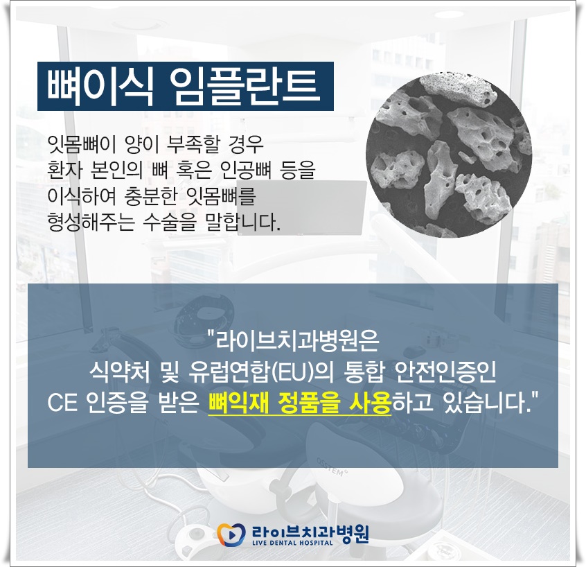 앞니임플란트 부작용 위험을 줄이기 위해서는? 관련 이미지 5