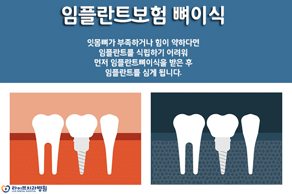 임플란트뼈이식 필요한 이유를 알아보자! 관련 이미지 2